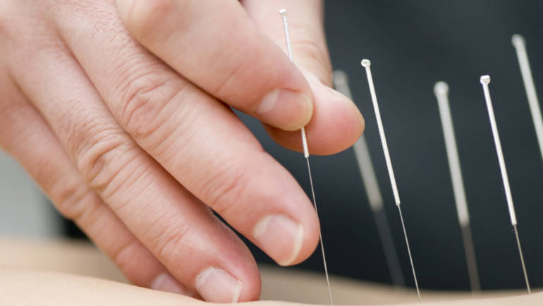 Myotherapy – Dry Needling